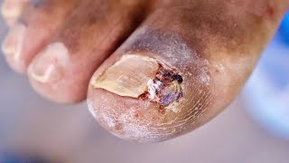 His Last Surgery FAILEDJUICY INFECTED INGROWN TOENAIL [upl. by Wamsley83]