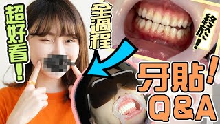 【 牙🦷 】諗咗幾年🔥 我做牙貼啦 ‼️ 過程公開！ 解答大家的疑問🔎 牙貼 QampA❤️ 幾錢？洗唔洗磨牙？ ｜譚杏藍 Hana Tam [upl. by Alfonse]