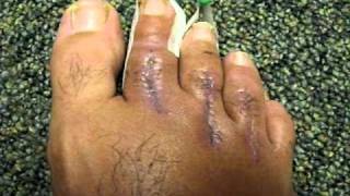 Post Hammertoe Surgery Update [upl. by Erreid]