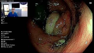 Screening colonoscopy [upl. by Crisey]