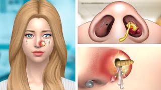 ASMR Removes Large Pimples amp Parasitic Worms on Nose  Deep Cleaning Animation [upl. by Monie]