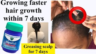 GREASING SCALP Everyday WITH VICKS VAPOUR RUB 7 DAY CHALLENGE Vicks vapour rub for hair growth [upl. by Adnik]