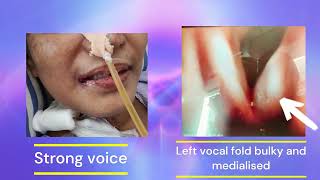 Injection Laryngoplasty  Dr Binhi Desai ENTamp VOICE SURGEON MUMBAI [upl. by Anis]