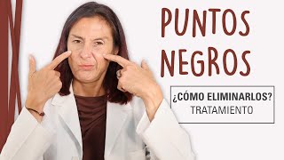 Puntos Negros en la Cara  Cómo Eliminarlos [upl. by Sabian]