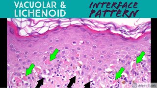 Vacuolar vs Lichenoid Interface Dermatitis Pattern  Inflammatory Dermpath Basics [upl. by Downing]