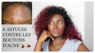 6 Astuces pour ce débarrasser des boutons pendant la nuit 🌙 [upl. by Carlee]