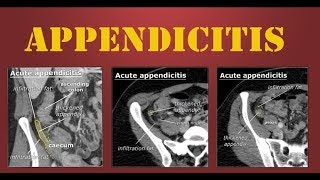 Appendicitis [upl. by Liatris]