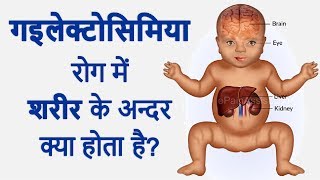 GALACTOSEMIA रोग क्या होता है SYMPTOMS CAUSES amp TREATMENT IN HINDI [upl. by Ricard]