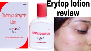 Erytop Lotion for pimples best lotion for acne and pimplessk fashion lifestyle [upl. by Oalsinatse7]