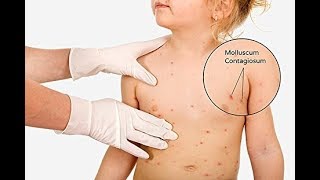 Home Remedies for Molluscum Contagiosum [upl. by Ythomit]