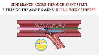 Side Branch Access through Stent Strut Dual Lumen Technique [upl. by Beth133]