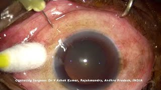 Intravitreal Ranibizumab injection [upl. by Akinaj]