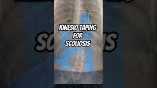 Kinesio Taping For Scoliosis ✅ poorposture scoliosis kinesiotaping physiofit physiotherapy [upl. by Nnave]