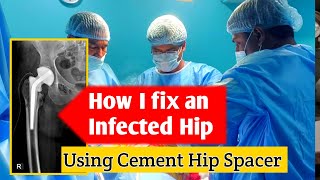 How do i fix an infected hip doctor hipsurgery hospital [upl. by Acirt764]