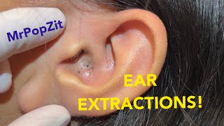 EAR EXTRACTIONS Must see giant ear blackheads extracted [upl. by Ailev]