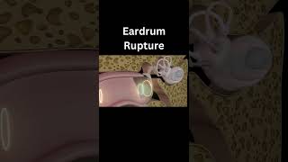 Ruptured Eardrum  3D Animation 👂 [upl. by Norrabal]