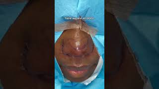 RHINOPLASTY BEFORE AND AFTER  DR TANVEER JANJUA  NEW JERSEY [upl. by Dressel]