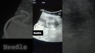 Liver abscess drainage [upl. by Shanahan]