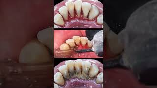 Scaling of Teeth [upl. by Sefton]