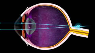 Short Sighted and Long Sighted  3D Medical Animation of the Eye  ABP © [upl. by Sucul]