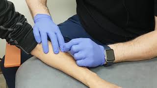 Dry Needling for Tennis Elbow [upl. by Jaret863]