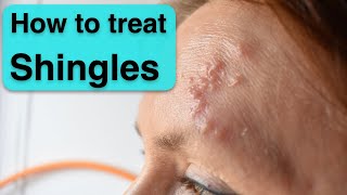 Herpes zoster Shingles treatment amp prevention [upl. by Cole]