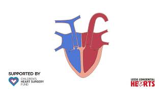 Tetralogy of Fallot [upl. by Mccoy959]