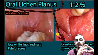 Oral Lichen Planus  Symptoms Causes Treatment Wickhams striae [upl. by Isidora]