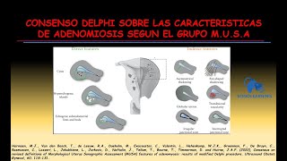 SIGNOS SUGESTIVOS DE ADENOMIOSIS [upl. by Saidee]