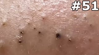 quot🔴 Satisfying Pimple Popping Extravaganza Watch the Most Satisfying Pops Everquot 51 [upl. by Ahcila]