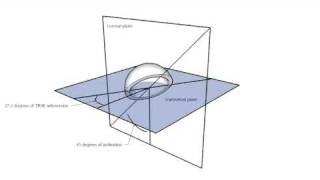 Anteversion and inclination of an acetabular cup [upl. by Teahan904]