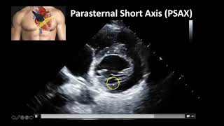 Cardiac Ultrasound Basic Windows and Anatomy [upl. by Isus]