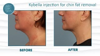 Kybella by Kythera injection fat removal from chin [upl. by Mackey]