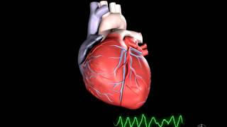 What is Ventricular Fibrillation [upl. by Junko949]