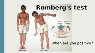 Rombergs test [upl. by Marsha]