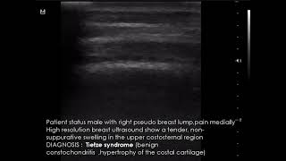 CASE 956 Tietze syndrome [upl. by Aldarcie]