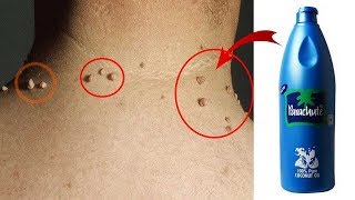 REMOVE SKIN TAG IN 15 DAYS BY APPLYING COCONUT OIL  100 Effective [upl. by Nylarahs]