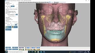 VSP  Virtual Surgical Planning orthognathic Dolphin [upl. by Hadik]