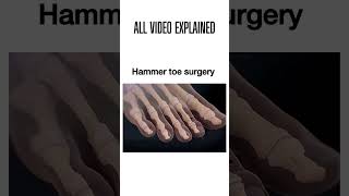 Hammer toe surgery hammertoe footsurgery podiatry foothealth surgeryrecovery [upl. by Kresic137]