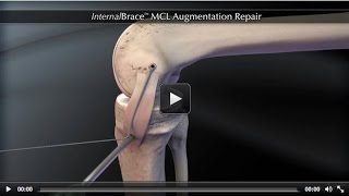 InternalBrace™ MCL Augmentation Repair [upl. by Schwenk]