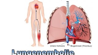 Lungenembolie  Krankheiten der Blutgefäße  Pflege Kanal [upl. by Zetnwahs175]