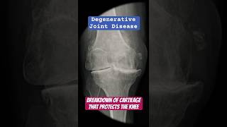 Degenerative arthritis of the knee health arthritis doctor [upl. by Pejsach200]