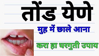 तोंड येणे घरगुती उपाय tond yene gharguti upay mouth ulcer home remedy [upl. by Nnairak]