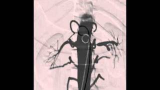 ANGIO Mentor  ANGIO Diagnostic Arteriogram [upl. by Egas929]