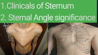 Significance of Sternal Angle Angle of Louis  Clinicals related to Sternum bone Dr Shayzee [upl. by Eisor]