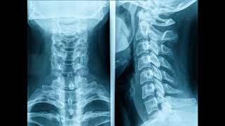 transverse process vertebral artery foramina foramen tranversarium on lateral view cervical spine [upl. by Dhaf161]