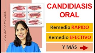 😬3 Remedios naturales para CANDIDIASIS oralesCándida AlbicanscausastratamientoEpisodio 61 [upl. by Ahsiener]