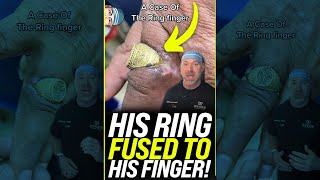 Ring Got Stuck and FUSED to His Finger 😱 shorts [upl. by Tremaine]