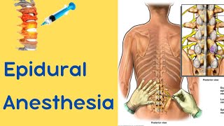 Epidural Anesthesia [upl. by Elam]