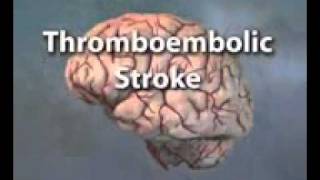 ACLS123COM STROKE VIDEO3gp [upl. by Malek131]